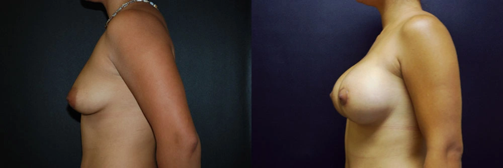 Real Patient Results in Newport Beach, CA. Preformed by Semira Bayait, MD, FACS.