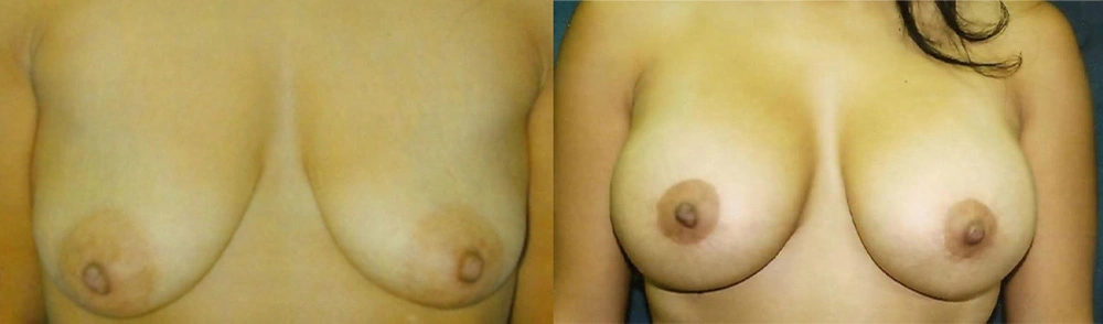 Real Patient Results in Newport Beach, CA. Preformed by Semira Bayait, MD, FACS.