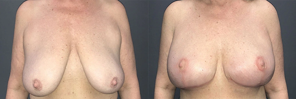 Real Patient Results in Newport Beach, CA. Preformed by Semira Bayait, MD, FACS.