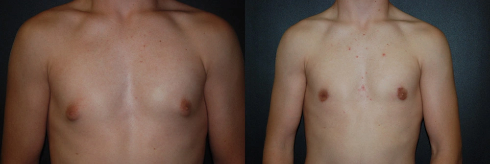 Real Patient Results in Newport Beach, CA. Preformed by Semira Bayait, MD, FACS.