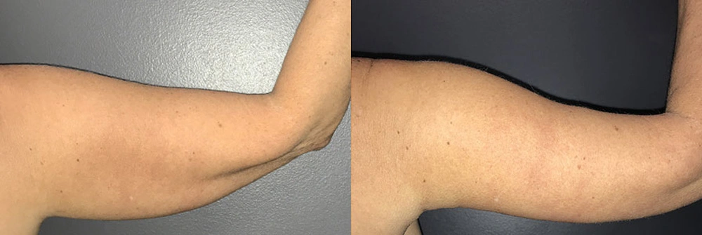 Real Patient Results in Newport Beach, CA. Preformed by Semira Bayait, MD, FACS.