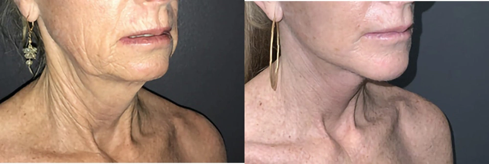 Real Patient Results in Newport Beach, CA. Preformed by Semira Bayait, MD, FACS.