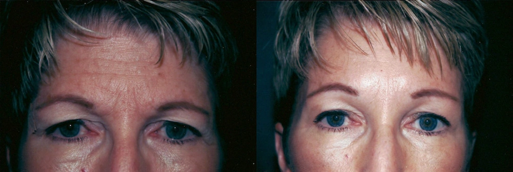 Real Patient Results in Newport Beach, CA. Preformed by Semira Bayait, MD, FACS.