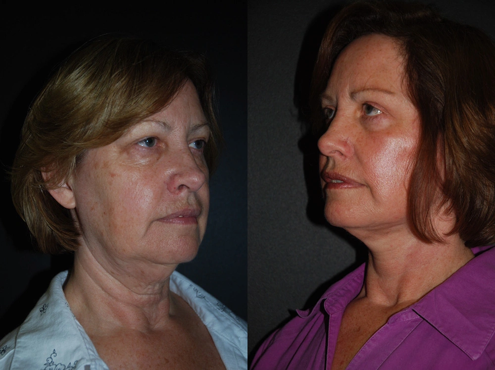 Real Patient Results in Newport Beach, CA. Preformed by Semira Bayait, MD, FACS.