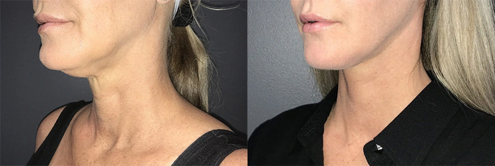 Real Patient Results in Newport Beach, CA. Preformed by Semira Bayait, MD, FACS.