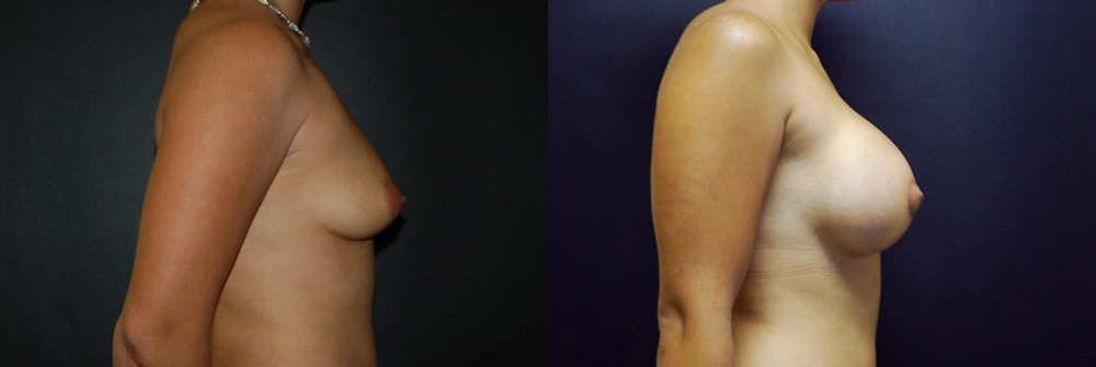 Real Patient Results in Newport Beach, CA. Preformed by Semira Bayait, MD, FACS.