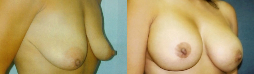 Real Patient Results in Newport Beach, CA. Preformed by Semira Bayait, MD, FACS.