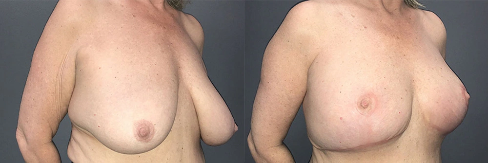 Real Patient Results in Newport Beach, CA. Preformed by Semira Bayait, MD, FACS.