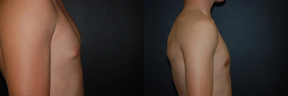 Real Patient Results in Newport Beach, CA. Preformed by Semira Bayait, MD, FACS.