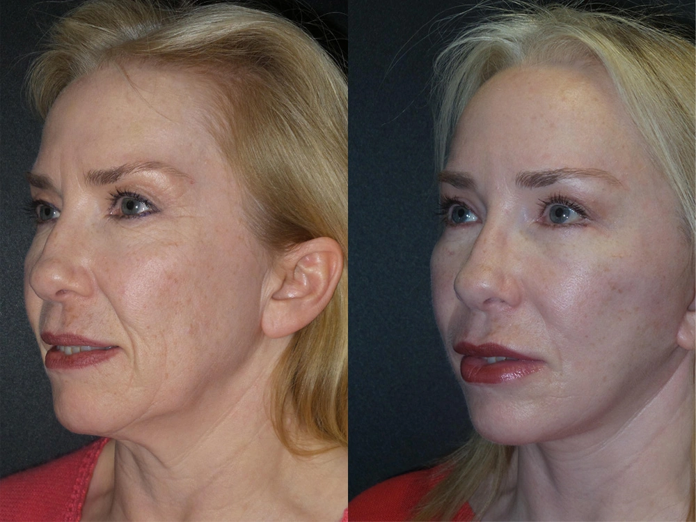 Real Patient Results in Newport Beach, CA. Preformed by Semira Bayait, MD, FACS.