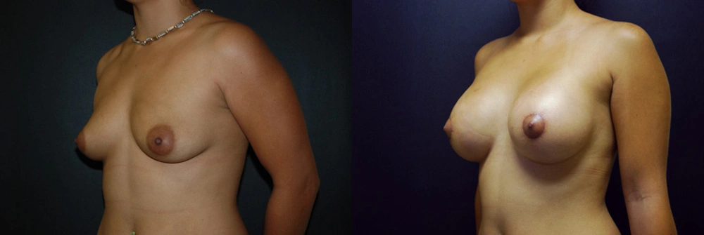 Real Patient Results in Newport Beach, CA. Preformed by Semira Bayait, MD, FACS.