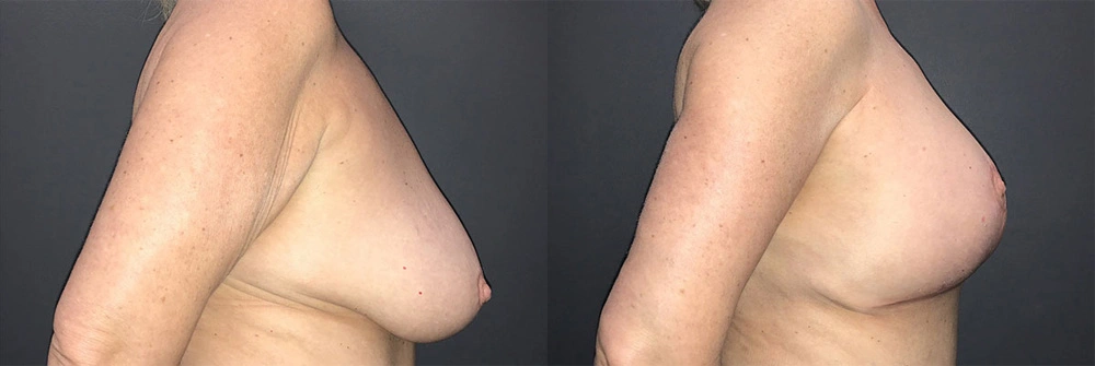 Real Patient Results in Newport Beach, CA. Preformed by Semira Bayait, MD, FACS.