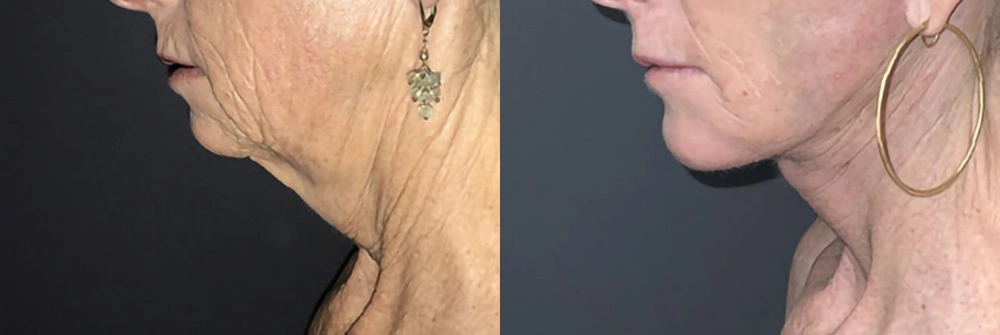 Real Patient Results in Newport Beach, CA. Preformed by Semira Bayait, MD, FACS.