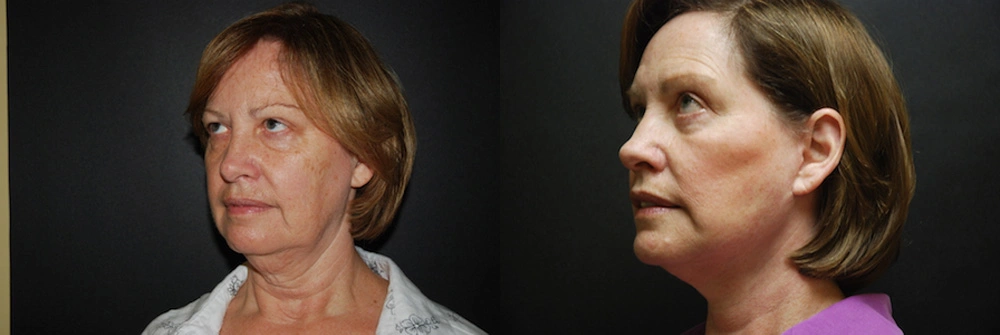 Real Patient Results in Newport Beach, CA. Preformed by Semira Bayait, MD, FACS.