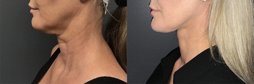 Real Patient Results in Newport Beach, CA. Preformed by Semira Bayait, MD, FACS.