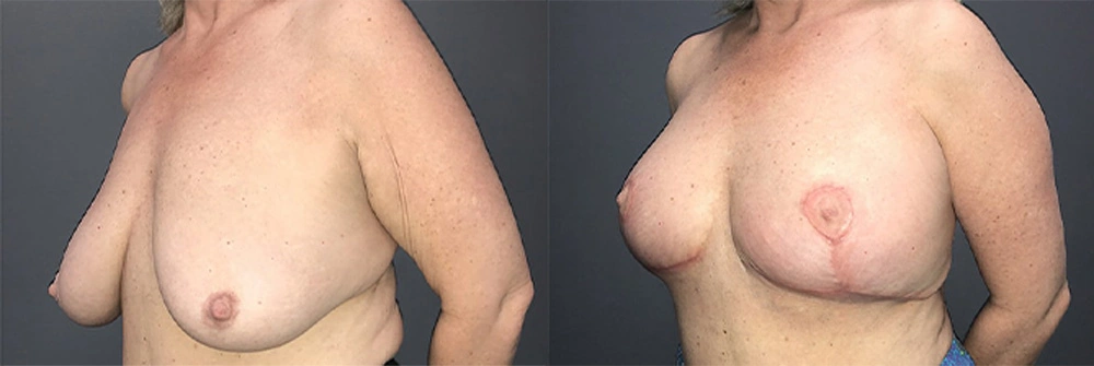 Real Patient Results in Newport Beach, CA. Preformed by Semira Bayait, MD, FACS.