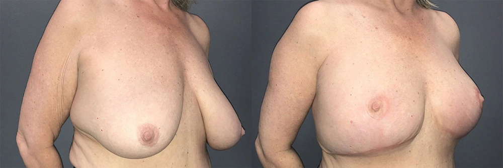 Real Patient Results in Newport Beach, CA. Preformed by Semira Bayait, MD, FACS.