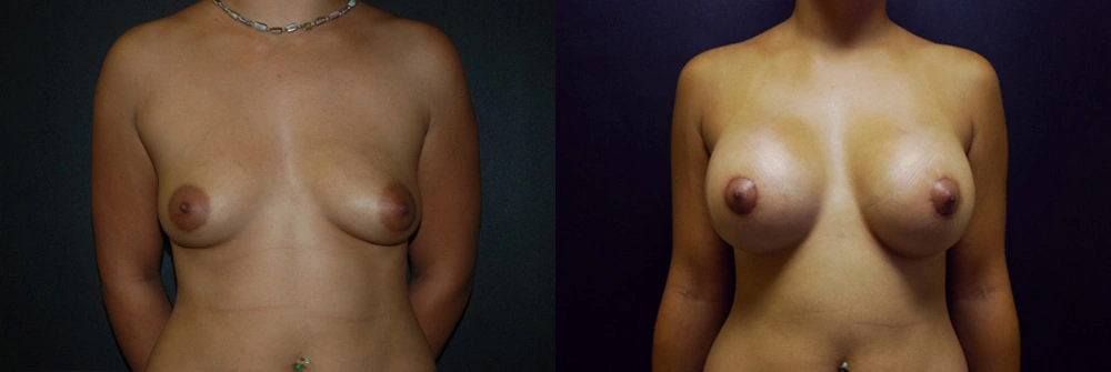 Real Patient Results in Newport Beach, CA. Preformed by Semira Bayait, MD, FACS.