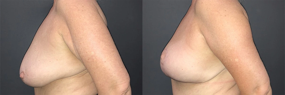 Real Patient Results in Newport Beach, CA. Preformed by Semira Bayait, MD, FACS.