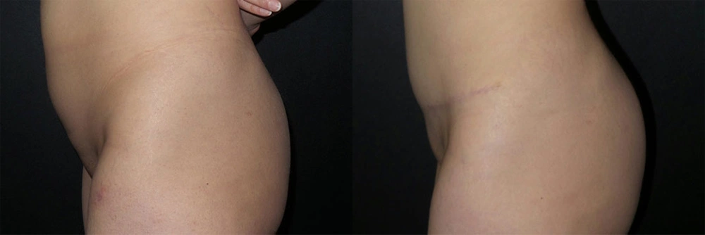 Real Patient Results in Newport Beach, CA. Preformed by Semira Bayait, MD, FACS.