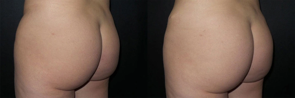 Real Patient Results in Newport Beach, CA. Preformed by Semira Bayait, MD, FACS.