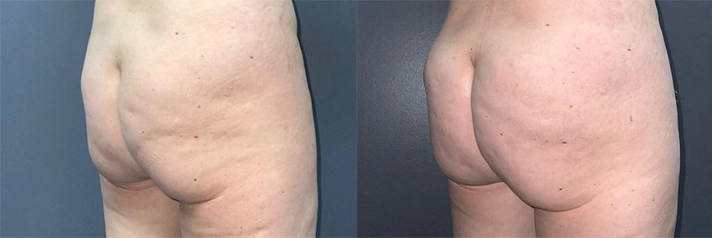 Real Patient Results in Newport Beach, CA. Preformed by Semira Bayait, MD, FACS.