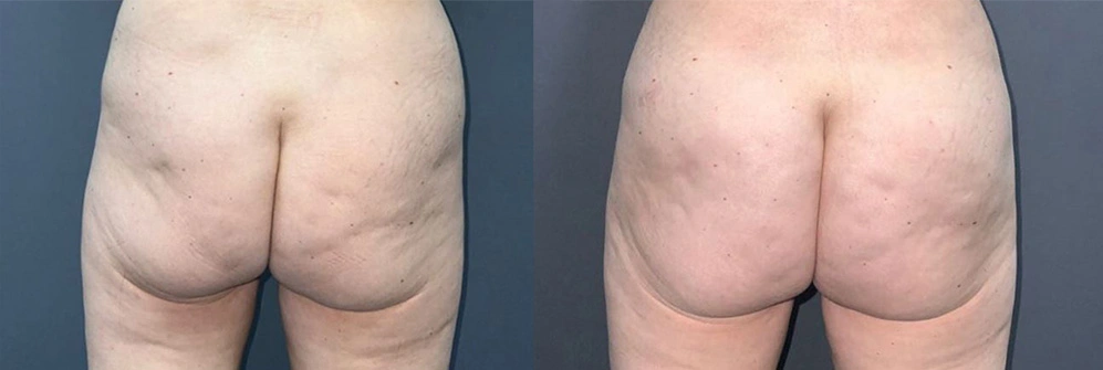 Real Patient Results in Newport Beach, CA. Preformed by Semira Bayait, MD, FACS.