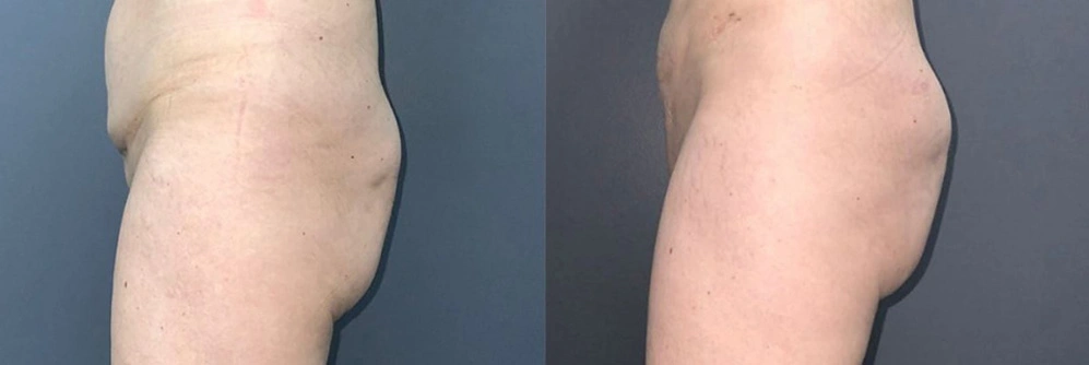 Real Patient Results in Newport Beach, CA. Preformed by Semira Bayait, MD, FACS.