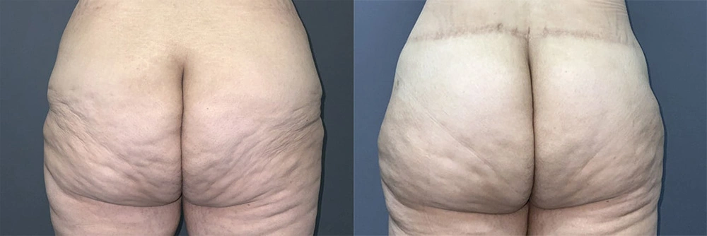 Real Patient Results in Newport Beach, CA. Preformed by Semira Bayait, MD, FACS.