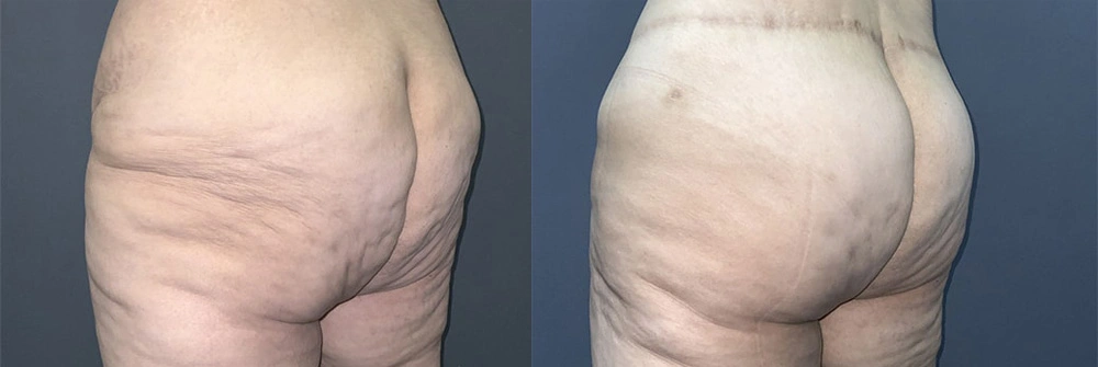 Real Patient Results in Newport Beach, CA. Preformed by Semira Bayait, MD, FACS.
