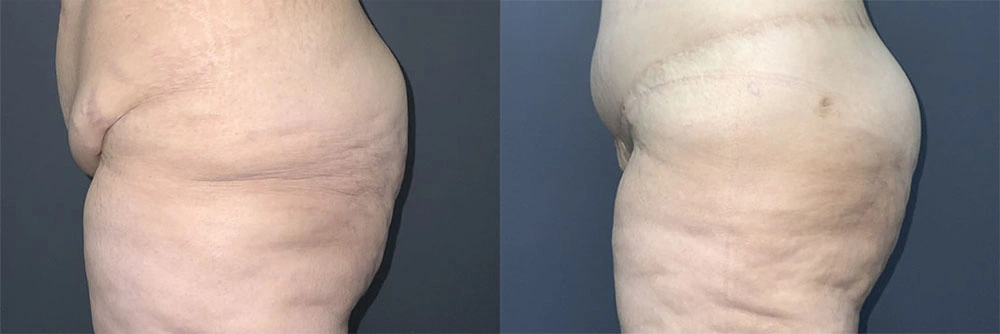 Real Patient Results in Newport Beach, CA. Preformed by Semira Bayait, MD, FACS.