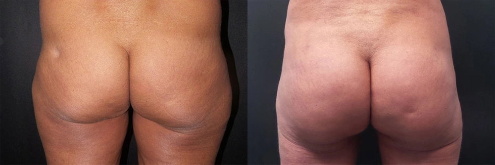 Real Patient Results in Newport Beach, CA. Preformed by Semira Bayait, MD, FACS.