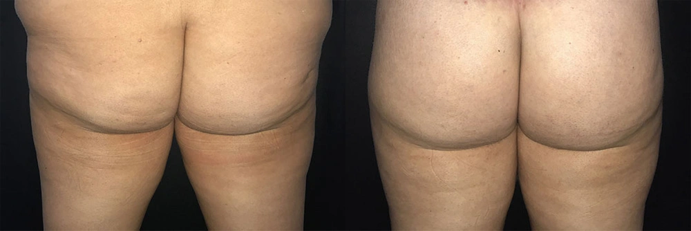 Real Patient Results in Newport Beach, CA. Preformed by Semira Bayait, MD, FACS.