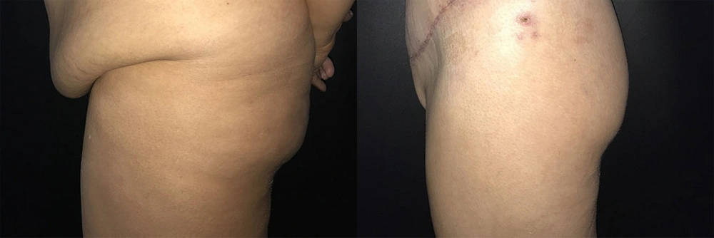 Real Patient Results in Newport Beach, CA. Preformed by Semira Bayait, MD, FACS.