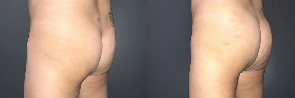 Real Patient Results in Newport Beach, CA. Preformed by Semira Bayait, MD, FACS.