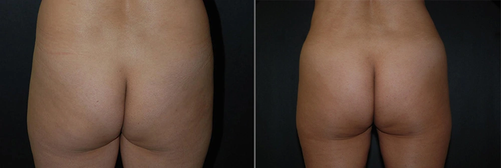 Real Patient Results in Newport Beach, CA. Preformed by Semira Bayait, MD, FACS.