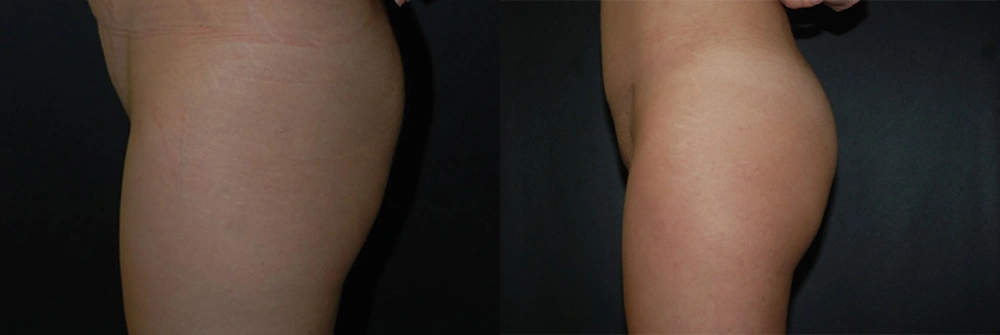 Real Patient Results in Newport Beach, CA. Preformed by Semira Bayait, MD, FACS.