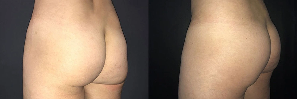 Real Patient Results in Newport Beach, CA. Preformed by Semira Bayait, MD, FACS.
