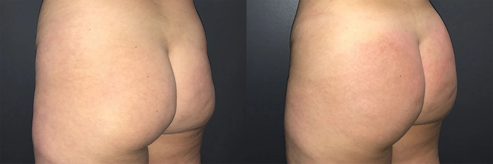 Real Patient Results in Newport Beach, CA. Preformed by Semira Bayait, MD, FACS.