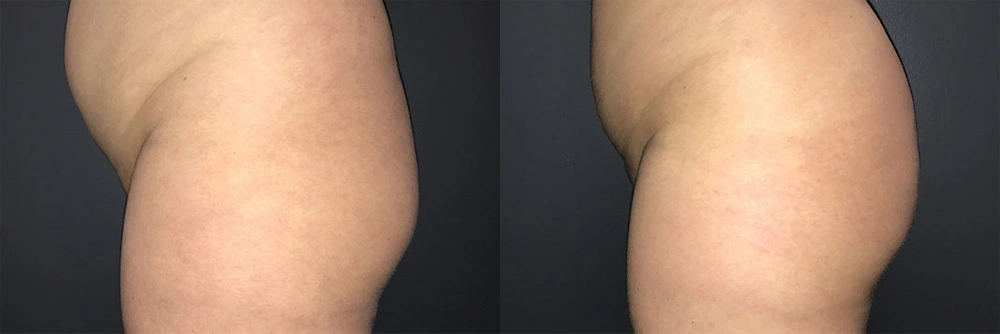 Real Patient Results in Newport Beach, CA. Preformed by Semira Bayait, MD, FACS.