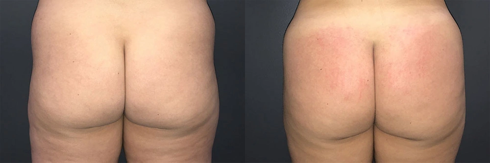 Real Patient Results in Newport Beach, CA. Preformed by Semira Bayait, MD, FACS.