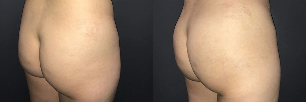 Real Patient Results in Newport Beach, CA. Preformed by Semira Bayait, MD, FACS.