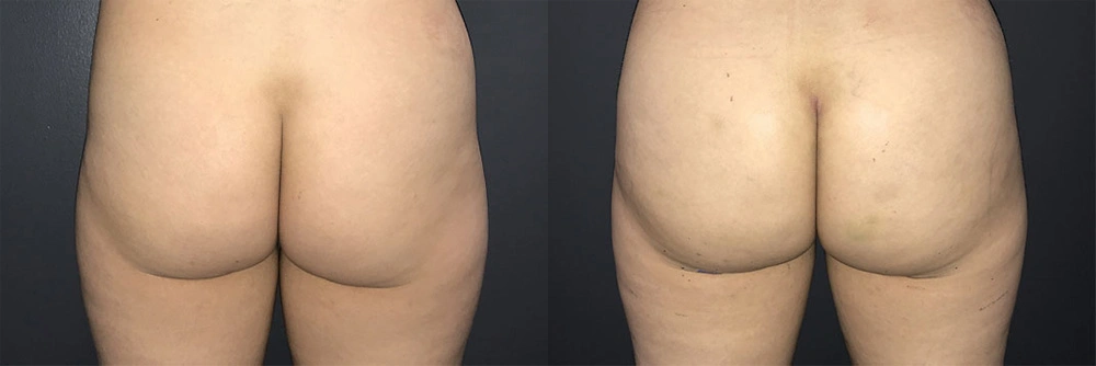 Real Patient Results in Newport Beach, CA. Preformed by Semira Bayait, MD, FACS.