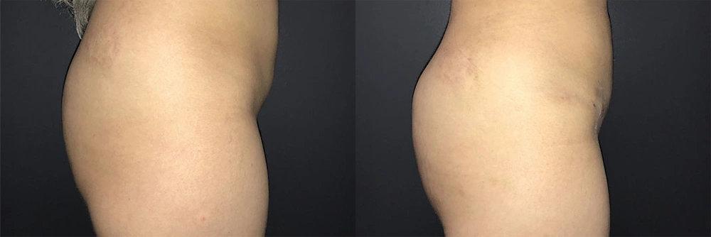Real Patient Results in Newport Beach, CA. Preformed by Semira Bayait, MD, FACS.