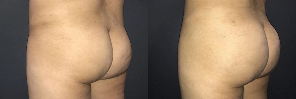 Real Patient Results in Newport Beach, CA. Preformed by Semira Bayait, MD, FACS.