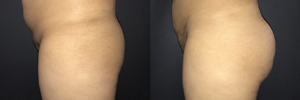 Real Patient Results in Newport Beach, CA. Preformed by Semira Bayait, MD, FACS.