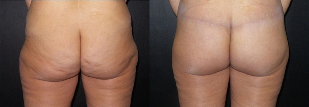 Real Patient Results in Newport Beach, CA. Preformed by Semira Bayait, MD, FACS.