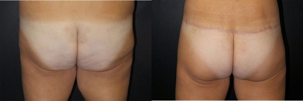 Real Patient Results in Newport Beach, CA. Preformed by Semira Bayait, MD, FACS.