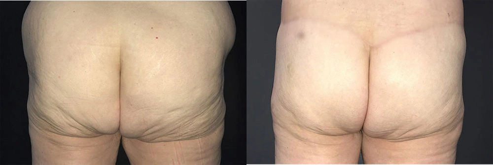 Real Patient Results in Newport Beach, CA. Preformed by Semira Bayait, MD, FACS.