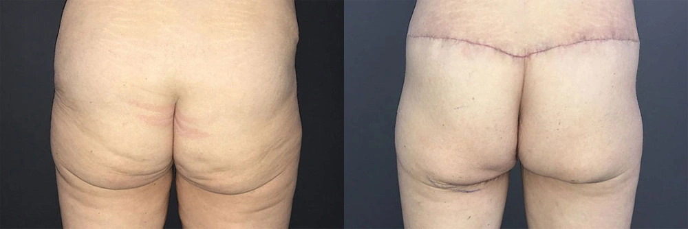 Real Patient Results in Newport Beach, CA. Preformed by Semira Bayait, MD, FACS.